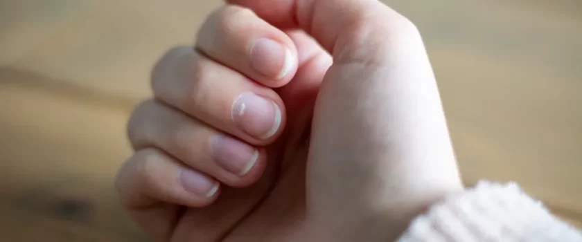 Tipos de vitíligo de las uñas