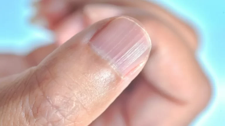Ondulaciones horizontales en las uñas